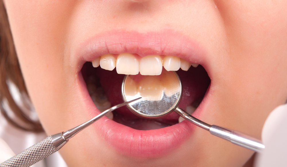 What to expect from a dental implant?